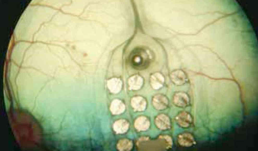 Implantat auf der Netzhaut lässt Blinde sehen