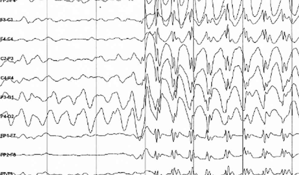 Ratten mit Epilepsie durch Gentherapie geheilt