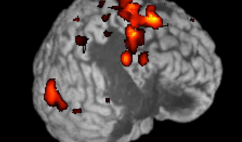 Schrittmacher für das Gehirn hilft Parkinson-Patienten