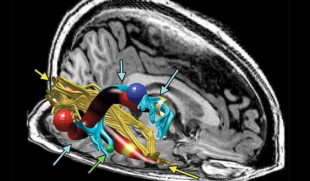 Drei Anomalien im Gehirn von CFS-Patienten entdeckt