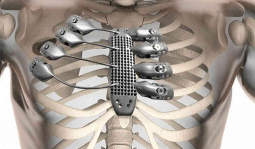 Krebs-Patient erhält Titanium-Brustkorb aus dem 3D-Drucker