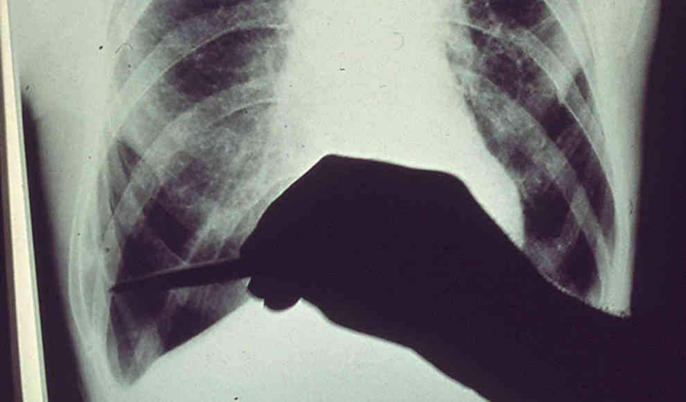 Neue Hoffnung für Lungenhochdruck-Patienten