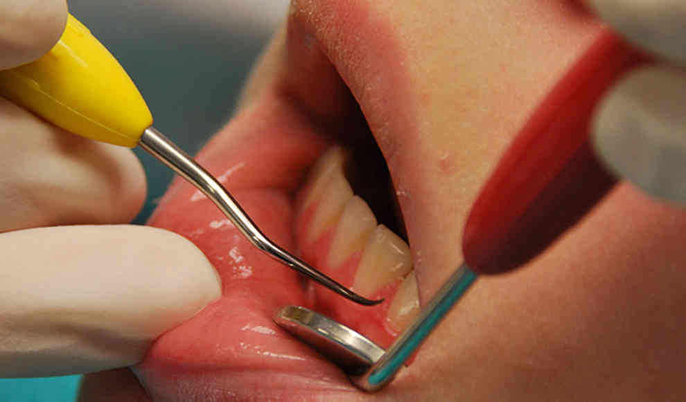 Tideglusib repariert Löcher in Zähnen