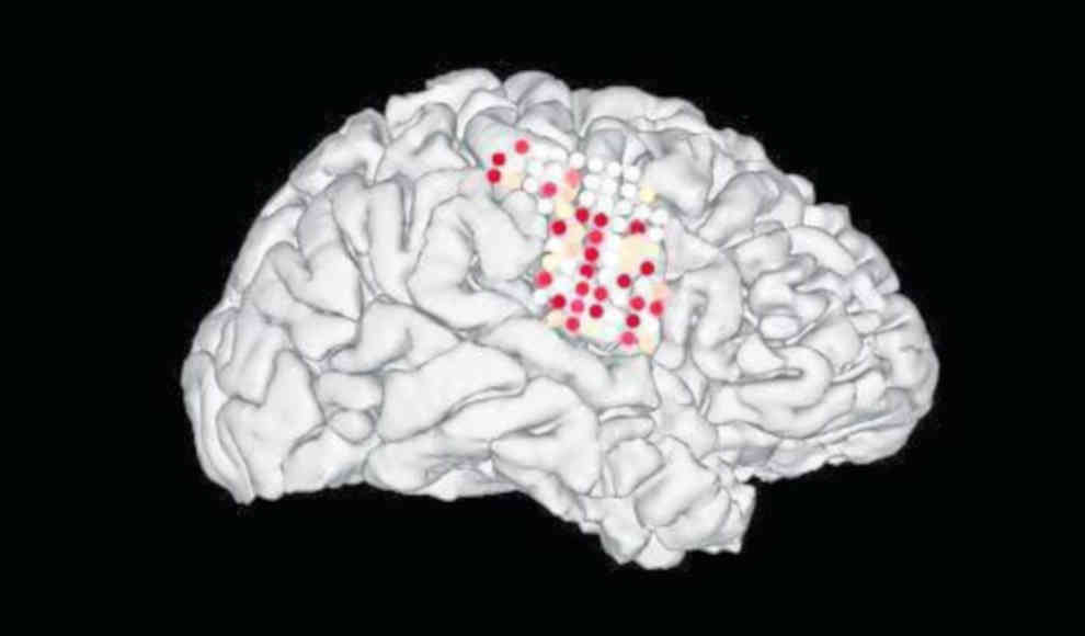 Gehirn-Computer-Schnittstelle übersetzt neuronale Signale in Sprache