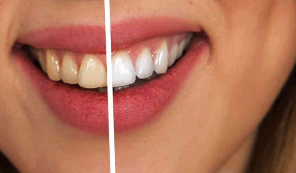 Elektrische Zahnbürsten gegen Parodontitis und Zahnausfall wirksamer