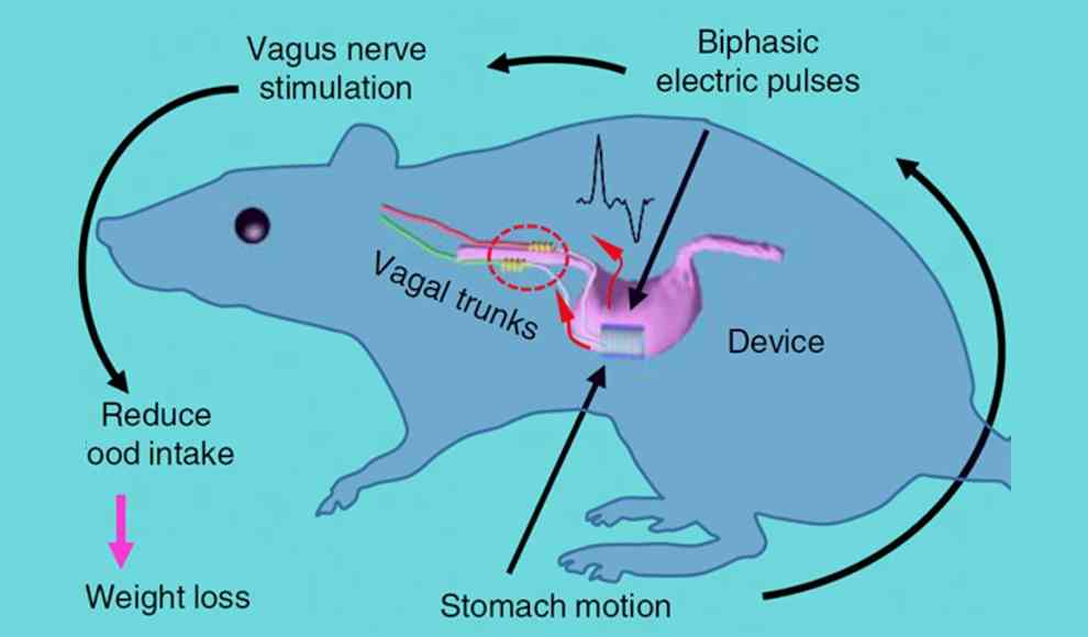 Mikro-Magen-Implantat verringert Hungergefühl