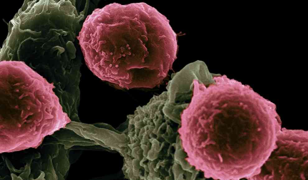 Brustkrebs macht Killerzellen zu Helfern