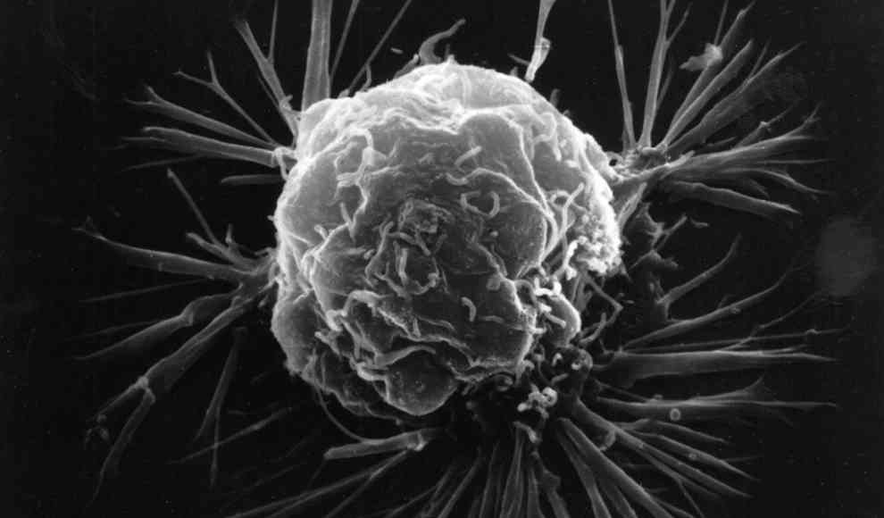 Krebszelle unter einem Rasterelektronenmikroskop