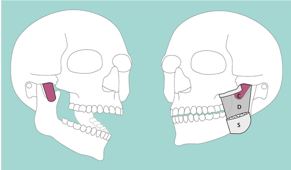 Musculus masseter pars coronidea (coronoider Teil des Masseters)