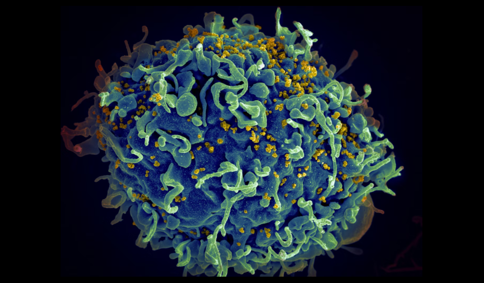 HIV (gelb) infiziert menschliche Zelle