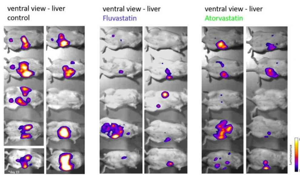 Cholesterin-Senker stoppen Krebs-Metastasen