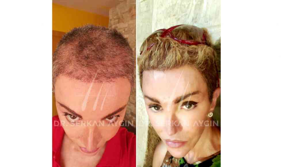 Haartransplantation: Vorher - Nachher