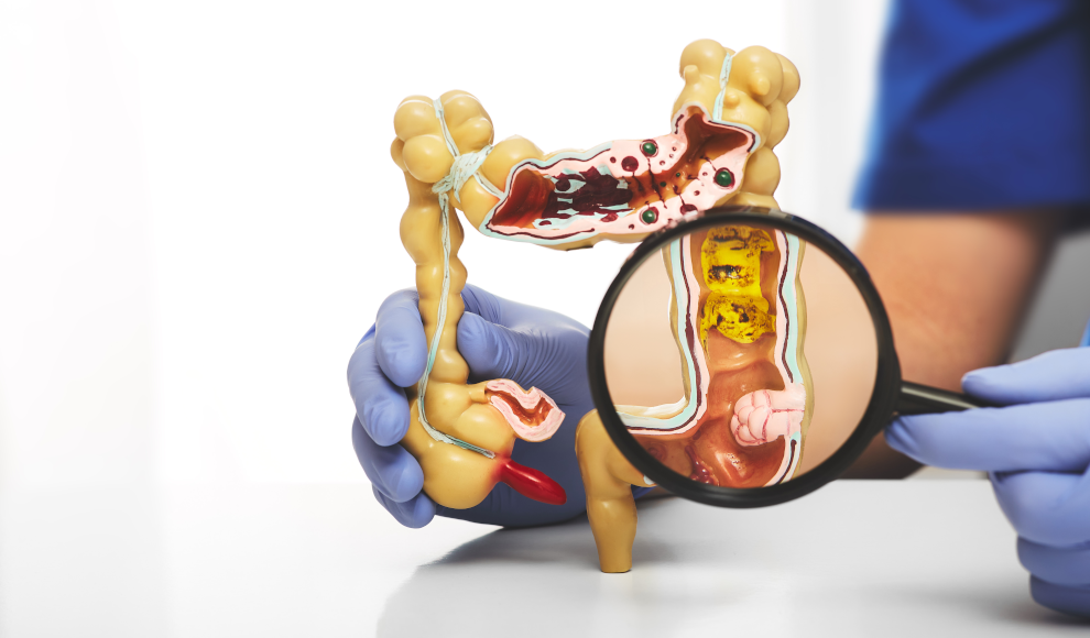 Darmmodell mit Morbus Crohn 