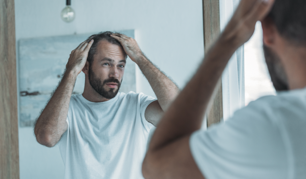 Mann mit Haarausfall