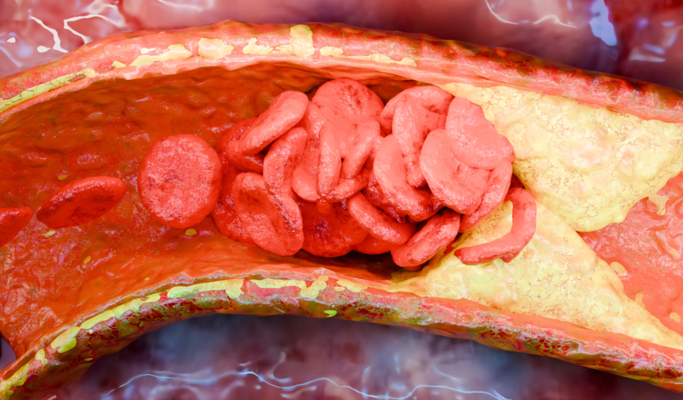 Bakterieller Biofilm verursacht Herzinfarkt
