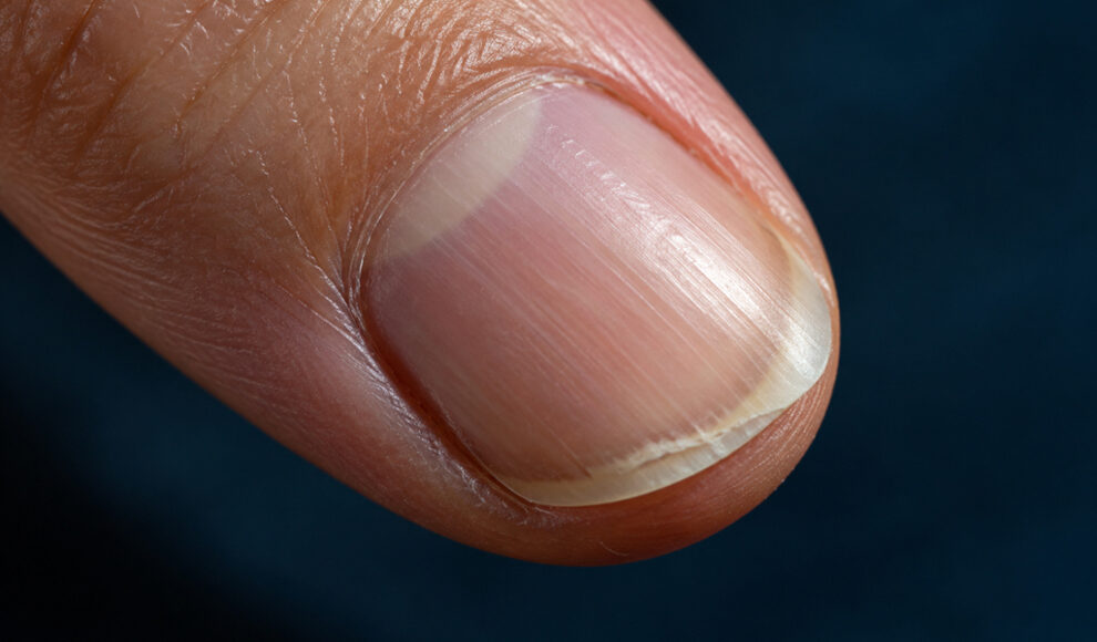 Abnehmspritzen gehen bei 39 Prozent mit Nagelablösung einher