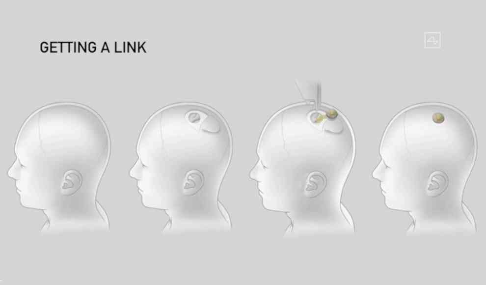 Neuralink Implantat